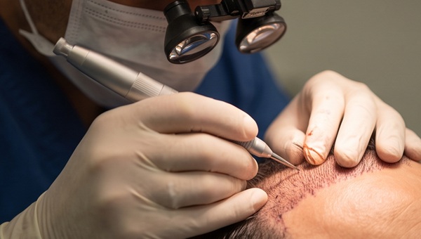 Highly magnified view of a skilled technician's gloved hand using an advanced implanter pen for direct hair implantation (DHI) into the recipient area hairline