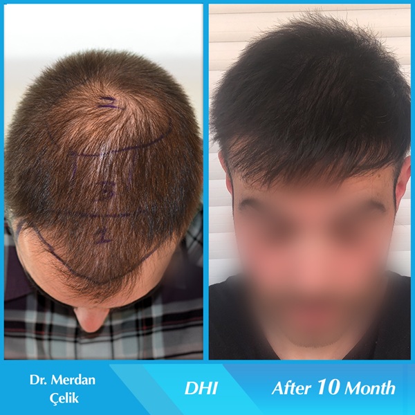 Dr. Merdan Çelik After and Before DHI Tecnique