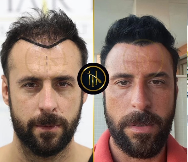 Before and after 2500 grafts FUE hair transplant results showcasing natural hairline restoration