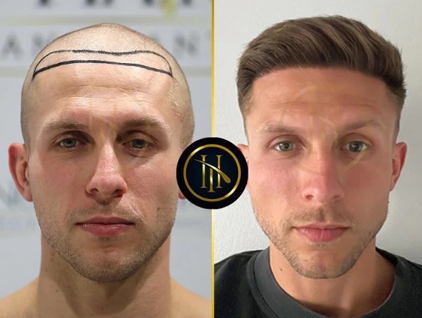 Before and after 2800 grafts Sapphire FUE hair transplant results showcasing natural hairline density