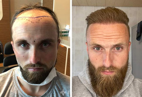 Before and after 4700 grafts Sapphire FUE hair transplant results showing hairline and crown restoration for a 28-year-old male patient with alopecia.