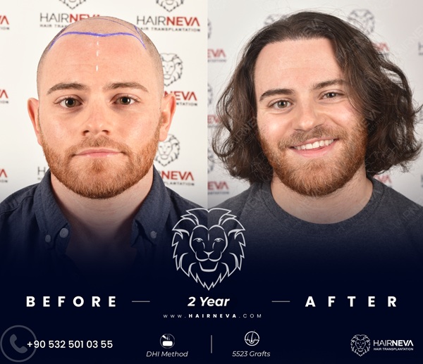 Before and after 5523 grafts DHI hair transplant results after 1 year at HairNeva.