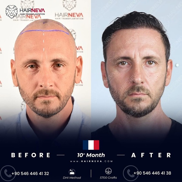 Before and after 5700 grafts DHI hair transplant results after 1 year at HairNeva.
