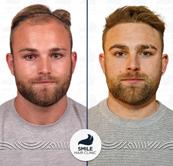 Before and after 3000 grafts DHI hair transplant results at Smile Hair Clinic.