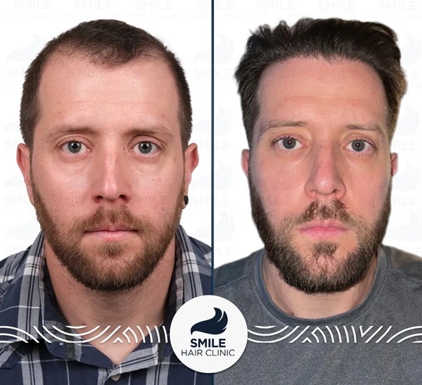 Before and after 5100 grafts Sapphire FUE hair transplant results at Smile Hair Clinic.