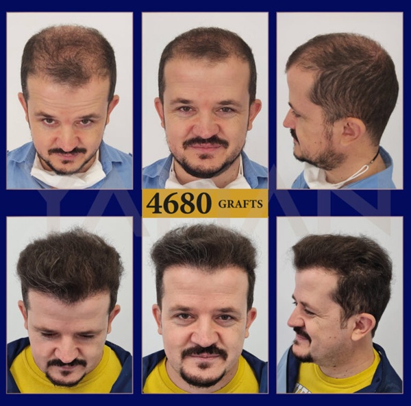 Before and after 3,800 graft FUE hair transplant results by Dr. Resul Yaman.