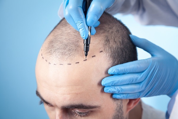 Por qué un trasplante de cabello de 2000€ en Turquía cuesta 12000€ en Londres