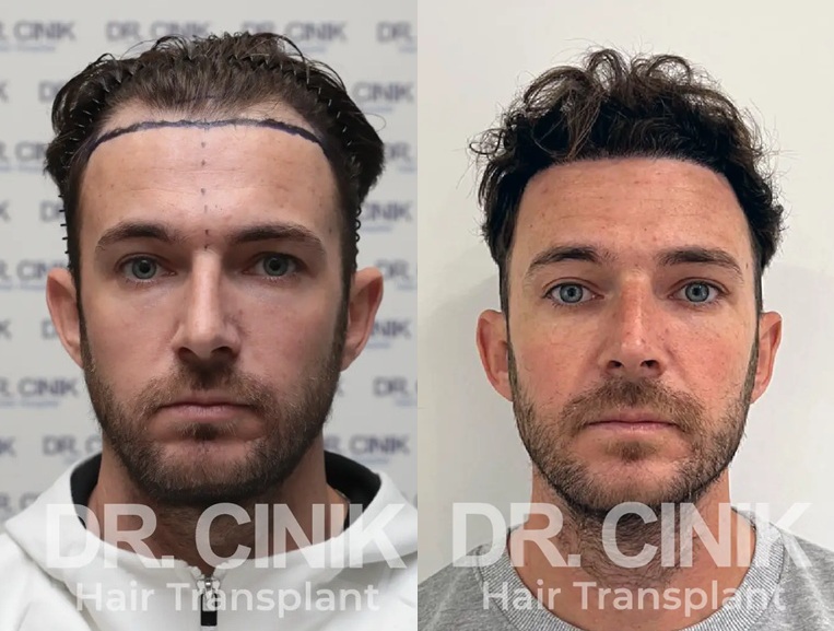 Resultados de antes y después de injerto capilar en Dr. Cinik Clinic