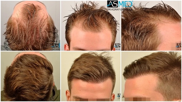 Résultats avant après greffe de cheveux à la clinique ASMED d'Istanbul (1950 greffons)