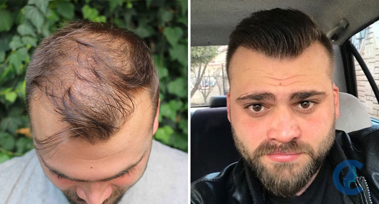 Résultats avant-après d'une greffe de cheveux à la clinique HLC d'Ankara (3800 greffons)
