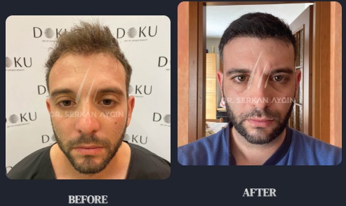 Avant et après greffe de cheveux importante par FUE Saphir à la clinique du Dr Serkan Aygin à Istanbul