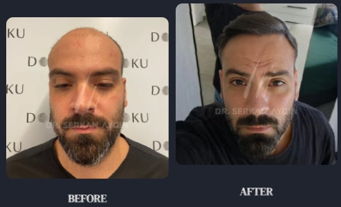 Résultats avant après greffe de cheveux à la clinique Dr Serkan Aygin avec la technique DHI