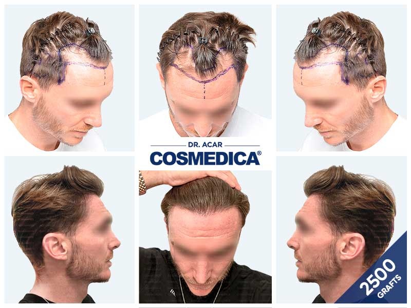 Risultati prima e dopo del trapianto di capelli scala Norwood 4 presso Cosmedica Clinic