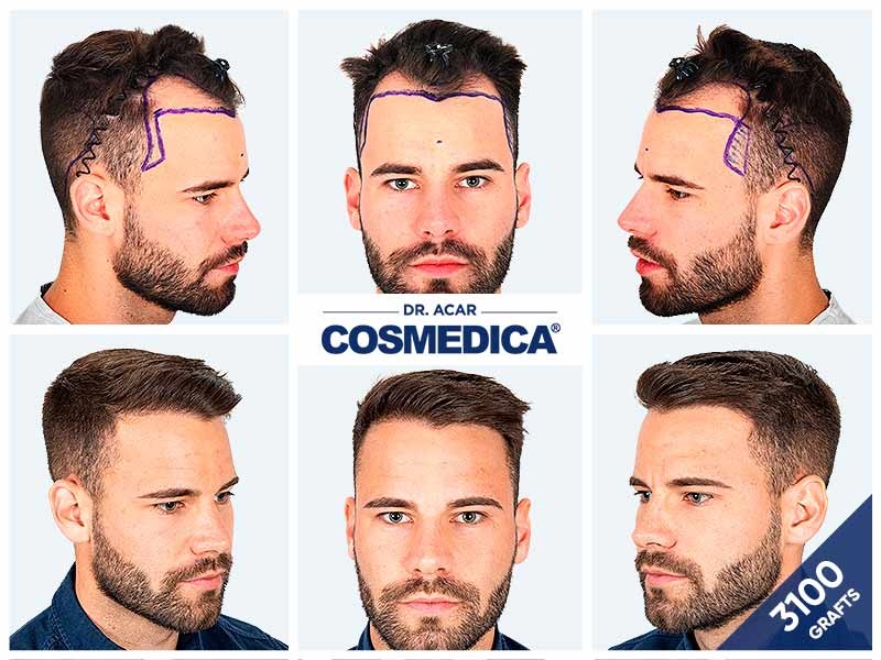 Risultati prima e dopo di densità capillare presso Cosmedica Clinic Istanbul