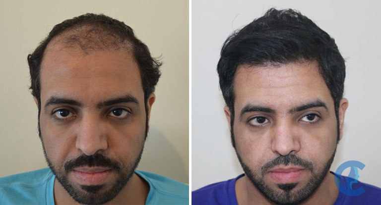Caso di riparazione trapianto capelli prima e dopo utilizzando estrazione manuale FUE presso HLC Ankara