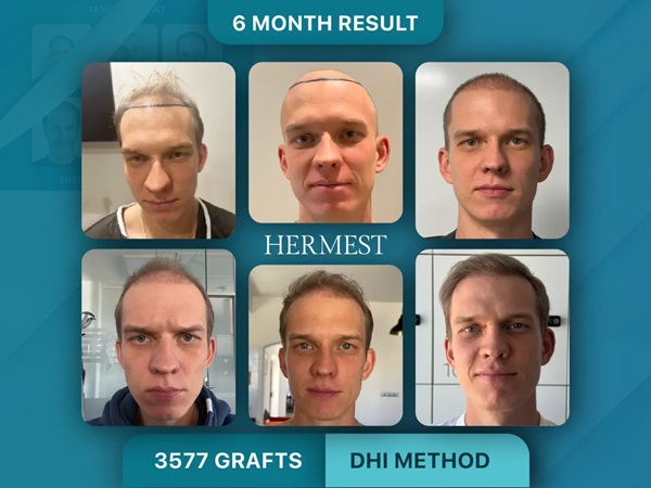 Prima e 6 mesi dopo il trapianto di capelli DHI da 3.577 innesti per un paziente svizzero presso la Hermest Hair Clinic.