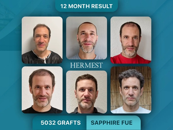 Prima e 12 mesi dopo il trapianto di capelli Zaffiro FUE da 5.032 innesti per un paziente svizzero presso la Hermest Hair Clinic.
