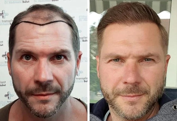 Risultati prima e dopo trapianto di capelli FUE Zaffiro da 4100 innesti con ripristino della densità del vertex per un paziente di 44 anni affetto da alopecia.