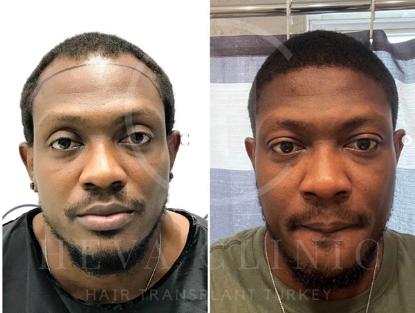 Risultati prima e dopo di trapianto di capelli afro presso la Heva Clinic.