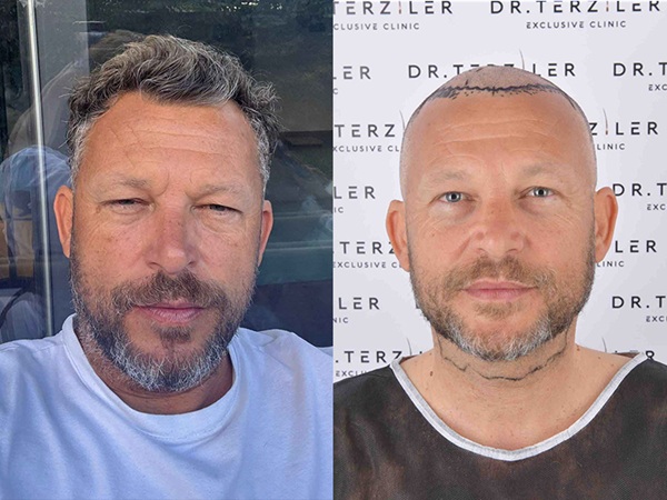 Risultati prima e dopo di restauro capillare DHI ad alta densità del Dr. Servet Terziler.